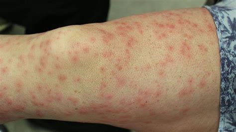 Eczema In Pictures What Do The Types Look Like