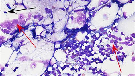 Image Gallery Lymph Node Cytology Clinicians Brief