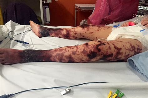 Girl Loses Both Legs After Doctors Mistake Meningitis For ‘tummy Bug