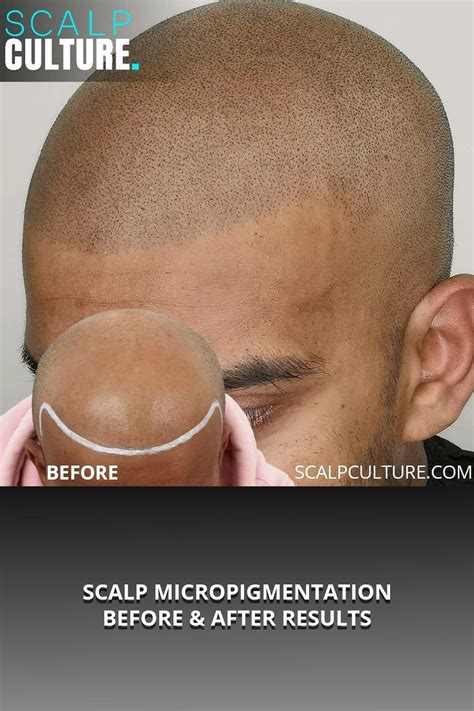 Scalp Micropigmentation Offered This Gentleman A Brand New Youthful