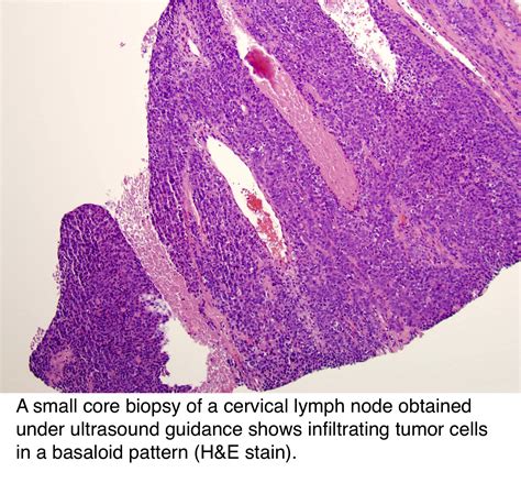 Hpv Related Head Neck Squamous Cell Carcinoma Incyte Diagnostics My