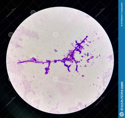 Budding Yeast Cells With Pseudohyphae In Urine Sample On Wright Gimsa Stain Stock Illustration