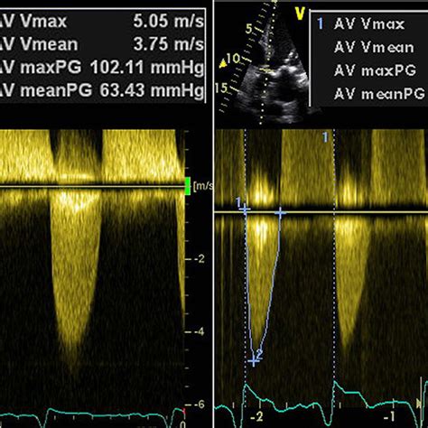 Hemodynamics Of Paradoxical Severe Aortic Stenosis Insight From A Pressure Volume Loop Analysis