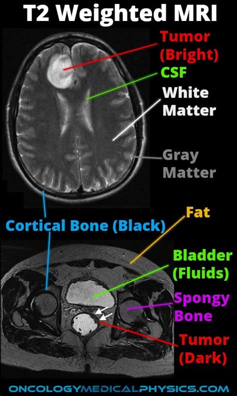 Mri Contrast Weighting Oncology Medical Physics