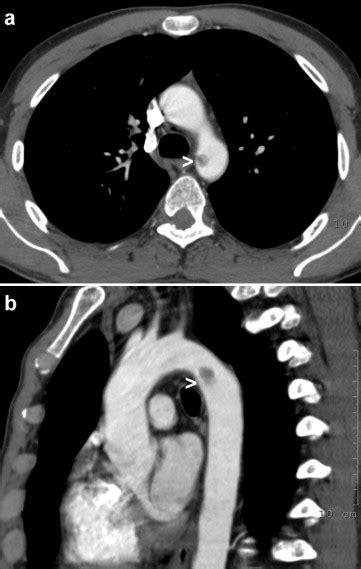 Isolated Floating Thrombus Of The Thoracic Aorta A Rare Sign Of