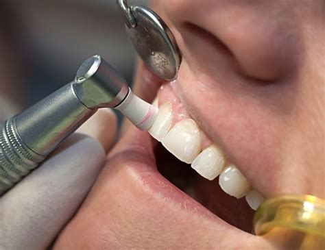 Professional Tooth Cleanings Santa Cruz Landmark Dental Group