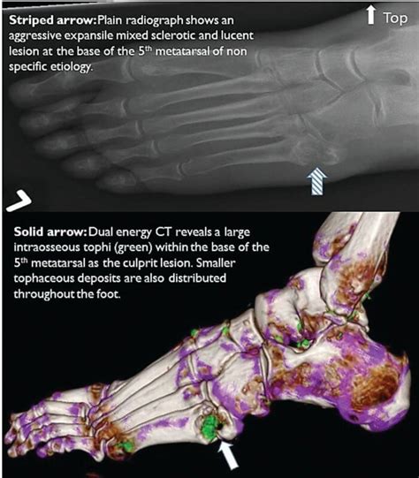 Gouty Tophi And Bone Erosion Goutpal Gout Help