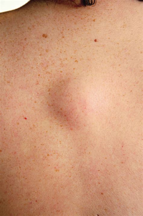 Lipoma Causes And Treatment Us Dermatology Partners