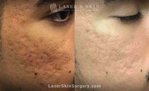 How To Treat Rolling Acne Scars Laser Ny