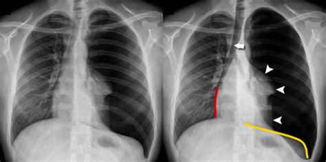 Chest X Ray Mild Pneumothorax