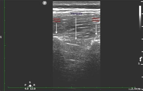 Ultrasound Guided Lumbar Puncture Emory School Of Medicine