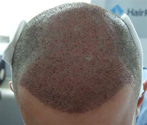 Patient de Hairpalace - greffe de 4200 cheveux