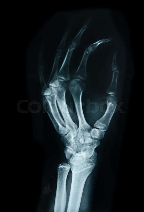 Carpal Bones Human X Ray Stock Image Colourbox