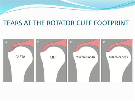 Tears At The Rotator Cuff Footprints Imaging Characteristic On Mri And