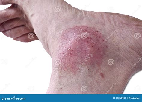 Psoriasis Skin Disease Stock Photo 122141124