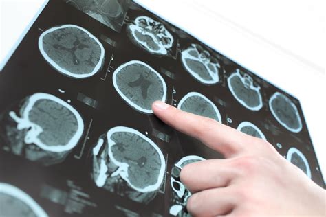 Melanoma Brain Metastases Suppress Immune Response Rely On Treatment