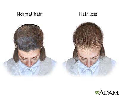 Female Pattern Baldness Symptoms Stages Causes Treatment OFF