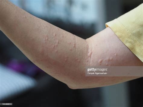 Woman Arm Swelling Red Blister Skin Rash Hit By Worm High Res Stock
