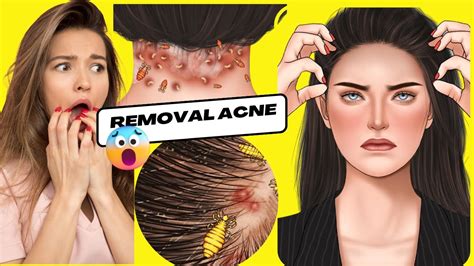 asmr treating seborrheic dermatitis acne and head lice on the nape and hairline through asmr