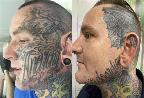 Before And After Tattoo Removal