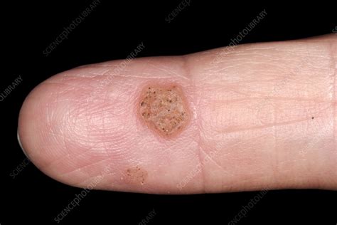 Wart Stock Image C0582420 Science Photo Library