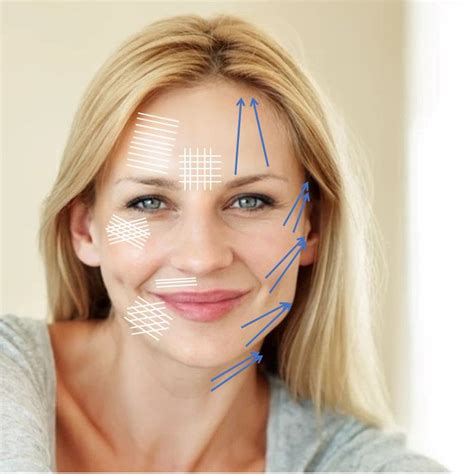 Complete Guide To Face Thread Lifts