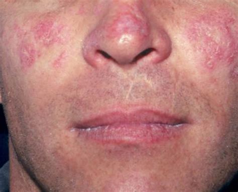 Lupus Systemic Lupus Erythematosus SLE Causes Sign Symptoms