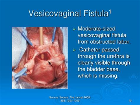 Ppt Obstetric Fistula An Overview Powerpoint Presentation Id6561245