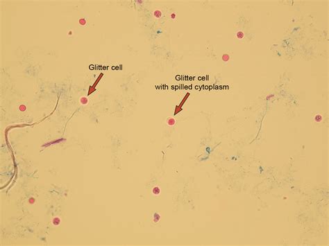 Cells In Urine Sediment Microscopic Examination Of Urine Sediment