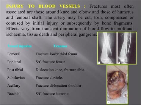 Complications Of Fractures 3pptnew