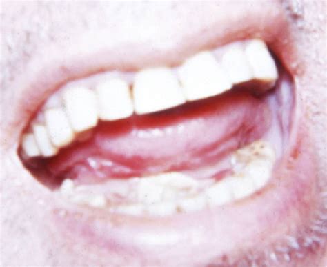 Swellings Within The Mouth Visual Diagnosis And Treatment In