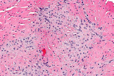 Fibromatoses Libre Pathology