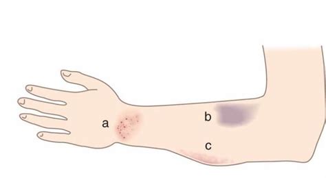 Ecchymosis Definition Pictures Symptoms Causes Treatment