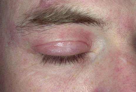 You may be familiar with the fact that eczema is a condition that can cause dry, itchy skin, a rash, and other symptoms, but you also probably wouldn't think it could bloom on your freaking eyelids. Eczema on Eyelids: Causes, Types and Treatment | EYExan.com