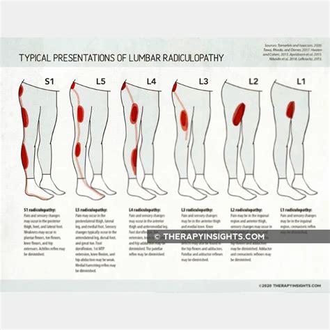 Lumbar Radiculopathy Typical Presentations By Level Adult And