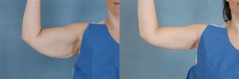 Arm Lift Brachioplasty Before And After Pictures Case 85