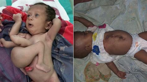 Baby Born With Parasitic Twin Has Extra Limbs Removed Parasite New