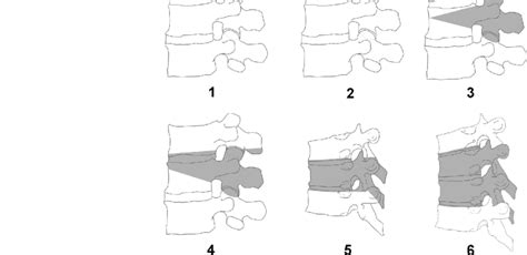 Osteotomy Classification Grades 16 According To The Anatomical