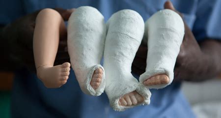 Sometimes nonsurgical treatments, such as casting, can correct clubfoot. What Are The Main Causes of Clubfoot?