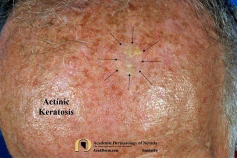 Actinic Keratosis Treatment Cryotherapy Academic Dermatology Of Nevada