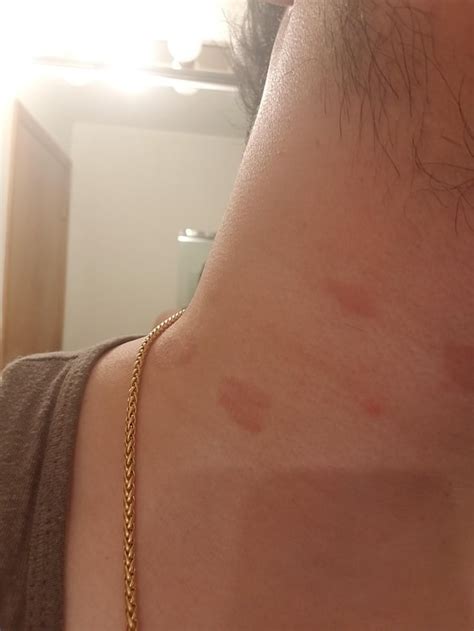 What Are These Red Spots On My Neck There Isnt Any Pain Or Irritation