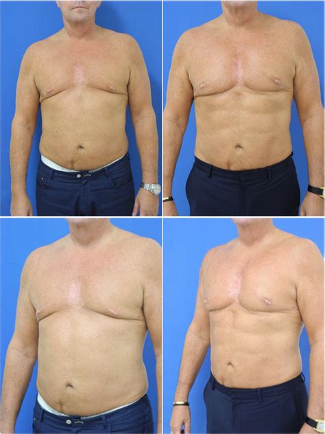 Liposuction Dr G Cosmetic Surgery