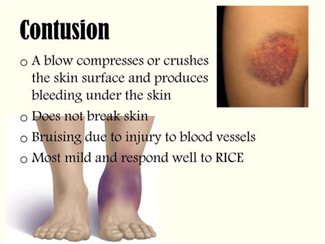 Contusion