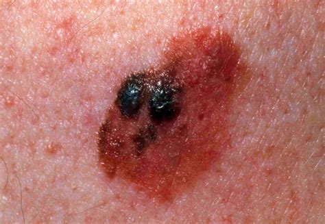Skin Cancer Moles On Back Idaman
