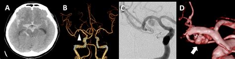 Cureus High Flow Bypass For Ruptured Aneurysms At Non Branching Sites