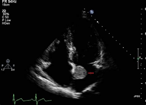 Left Atrial Myxoma A Case Report