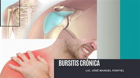 Los mejores ejercicios para la bursitis Crónica del hombro