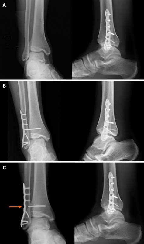 Acute Syndesmotic Injuries In Ankle Fractures From Diagnosis To