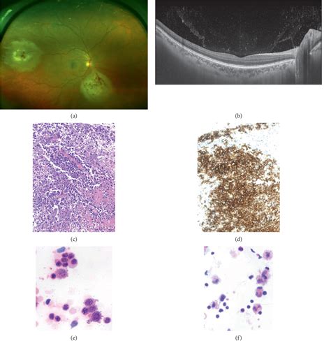 Figure 1 From Clinical Features Of Primary And Systemic Metastatic