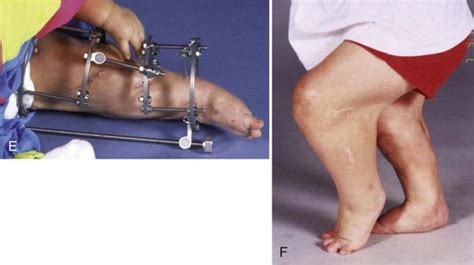 Congenital Deformities Of The Knee Musculoskeletal Key
